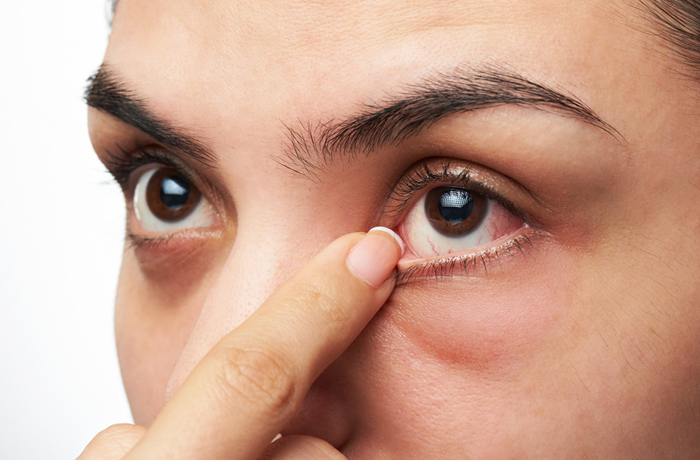 Trockene Augen können auch eine Folgeerkrankung sein, deswegen sollten Betroffene nicht nur den Augen-, sondern auch den Hausarzt aufsuchen.  